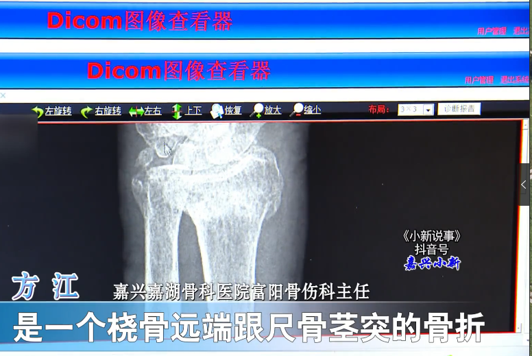 97歲高齡老人，傳統(tǒng)復(fù)位免于手術(shù)3.png